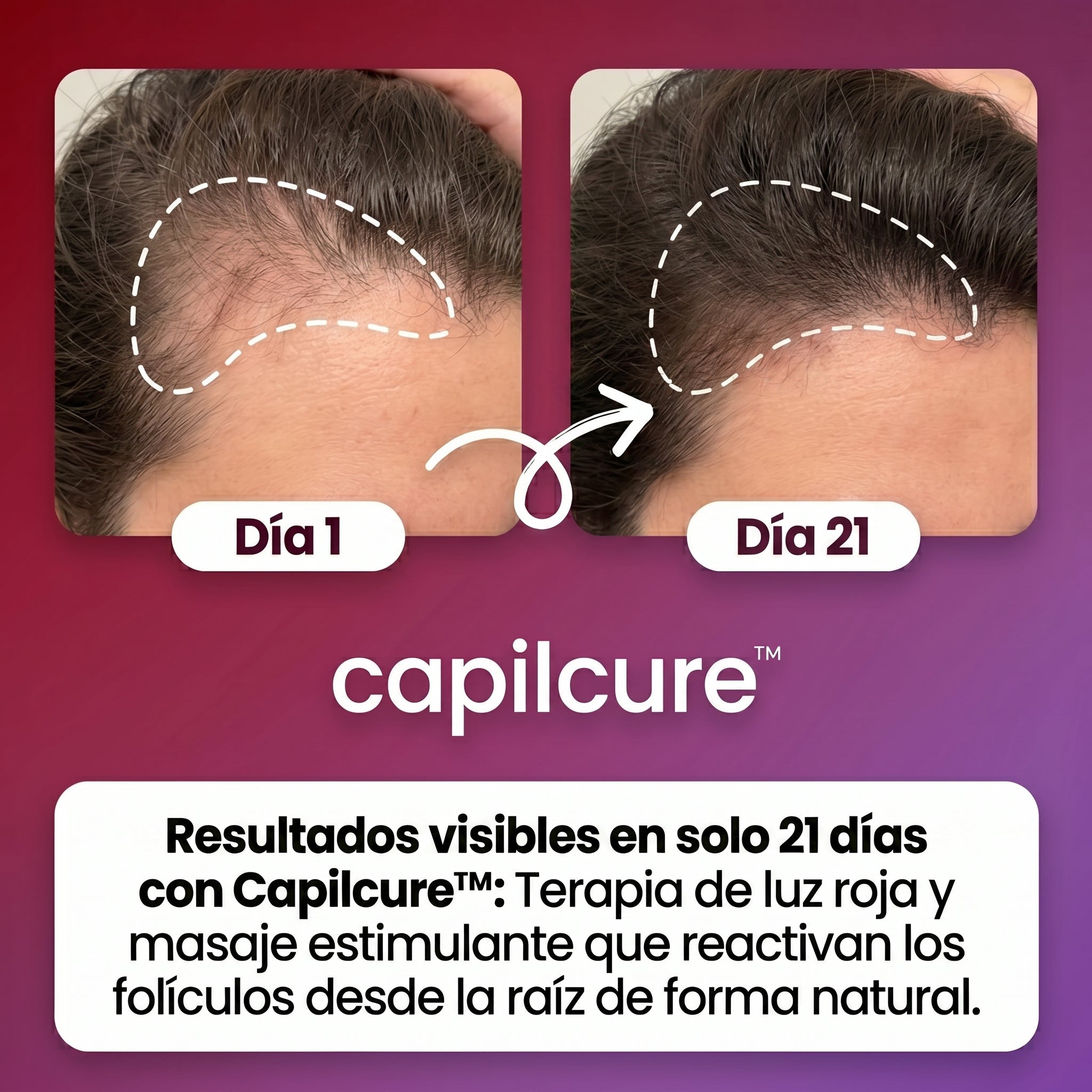 Capilcure™ DensiPulse